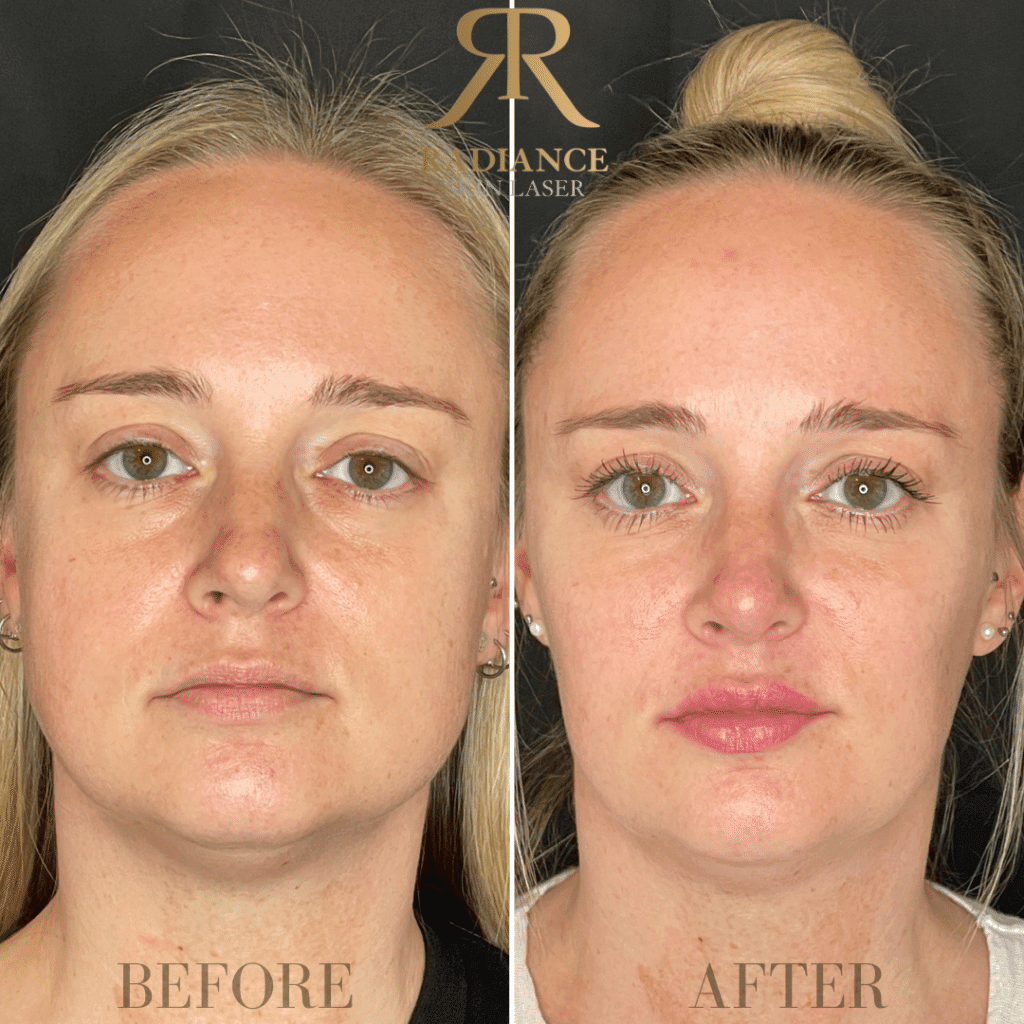 Dermal Fillers Before and After Images 5th | Radiance Skin and Laser | Bothell, WA