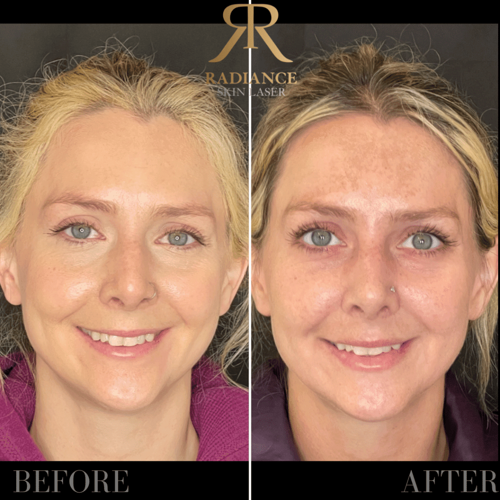 Dermal Fillers Before and After Images 4th | Radiance Skin and Laser | Bothell, WA