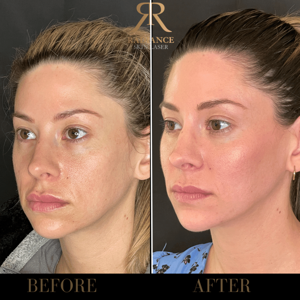 Dermal Fillers Before and After Images 3rd | Radiance Skin and Laser | Bothell, WA