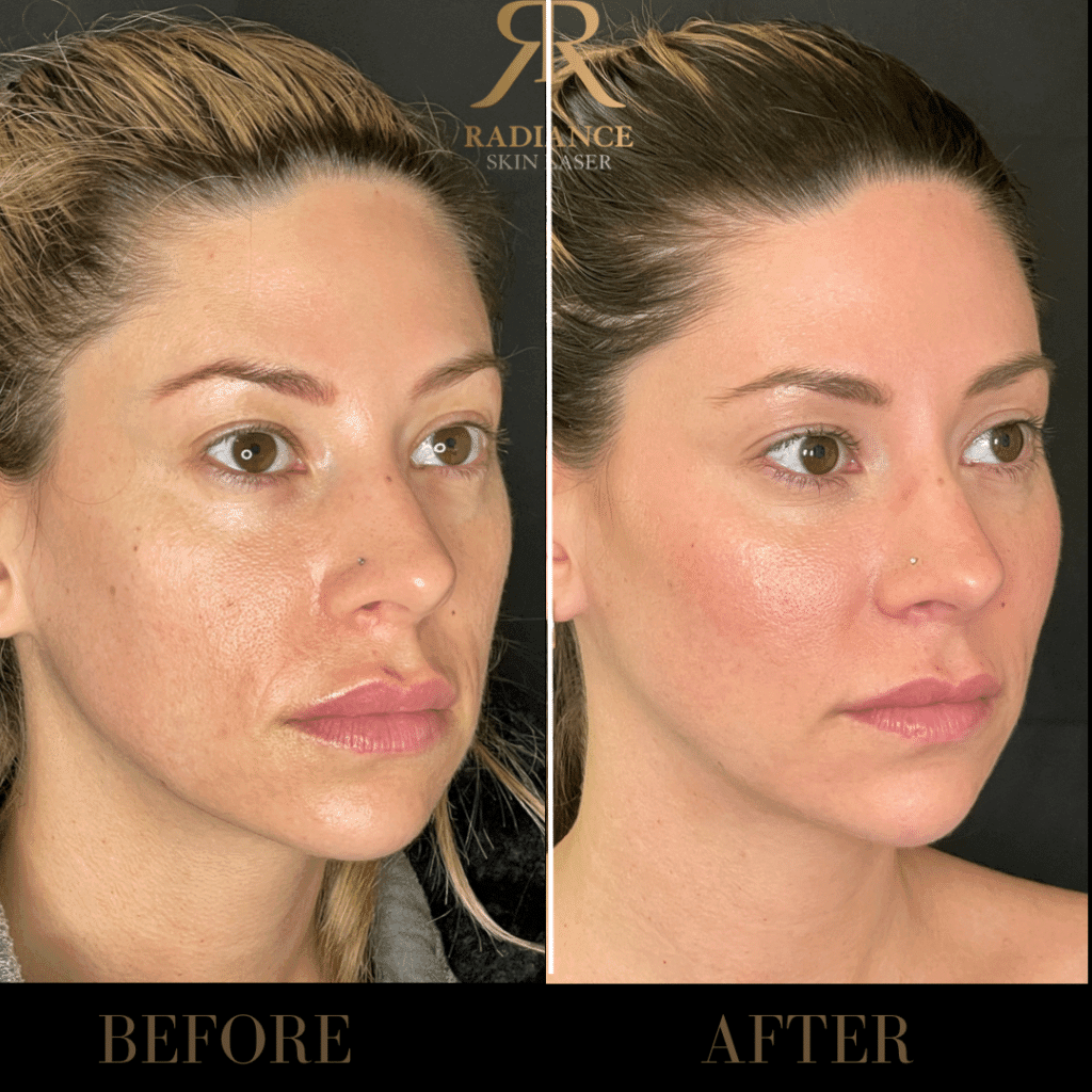 Dermal Fillers Before and After Images 2nd | Radiance Skin and Laser | Bothell, WA