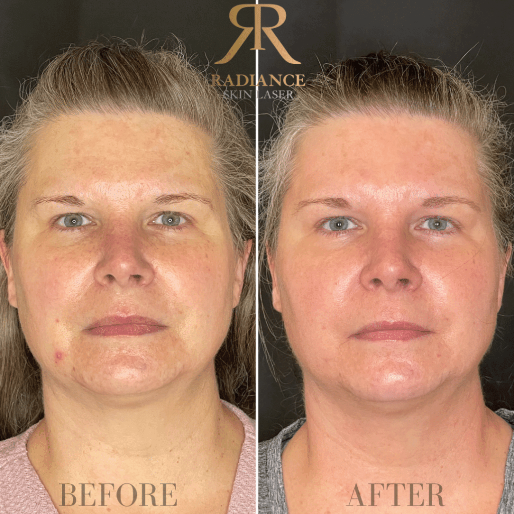 Skin Treatment Before and After Images | Radiance Skin and Laser | Bothell, WA