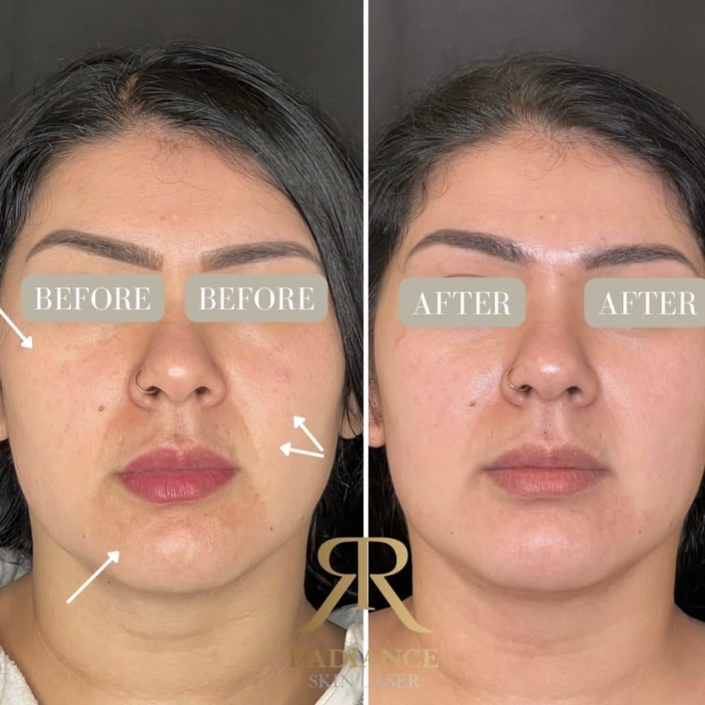 Botox Before and After | Radiance Skin and Laser | Bothell, WA