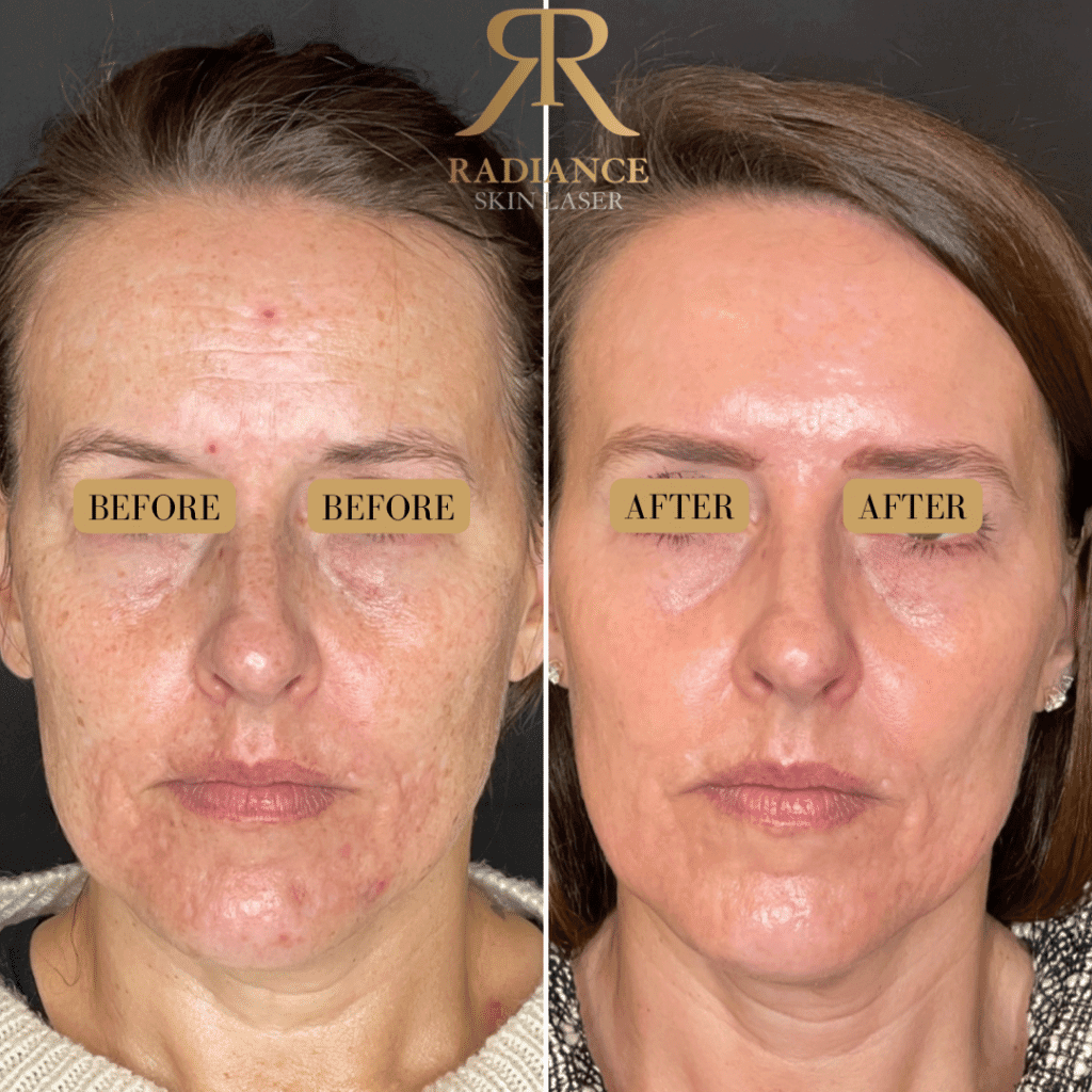 Wrinkle Treatment | Radiance Skin and Laser | Bothell, WA