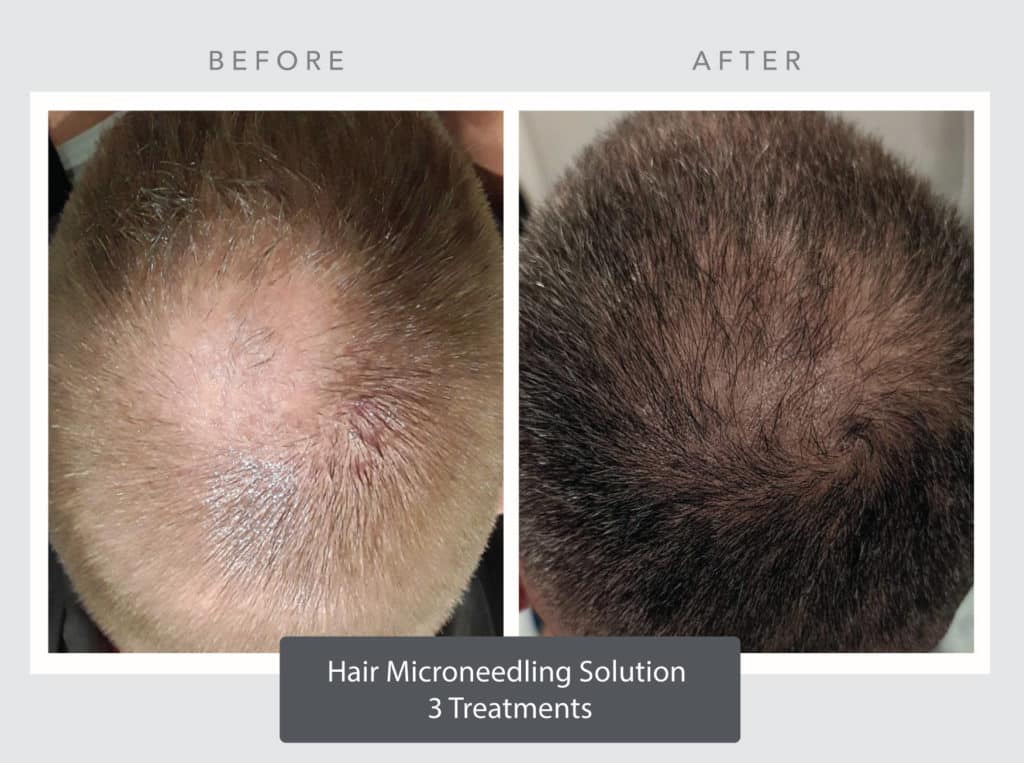 Hair Restoration Treatment by Radiance Skin and Laser in Bothell, WA