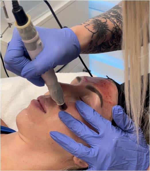 Microneedling Treatment by Radiance Skin and Laser