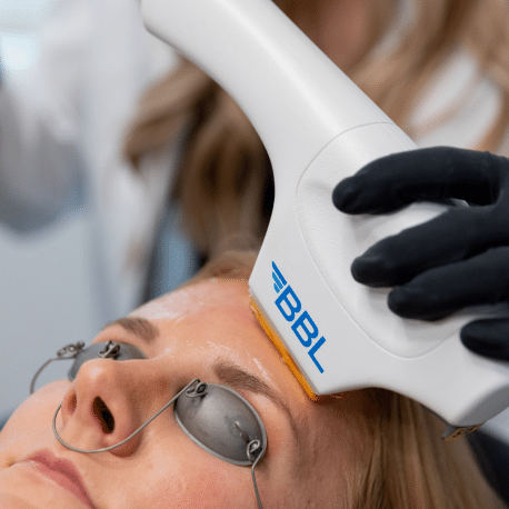 BBL Hero Laser in Kirkland, WA | Redness Treatment