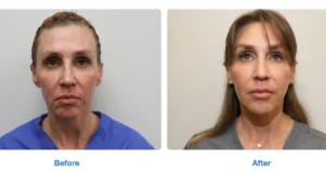 Sagging Neck treatment before and after Images 6th by Radiance Skin and Laser in Bothell, WA