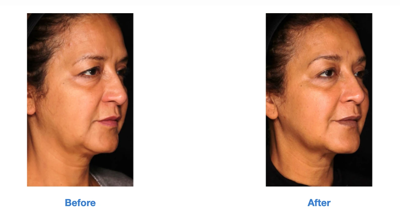 Skin firmness treatment before and after images by Radiance Skin and Laser in Bothell, WA