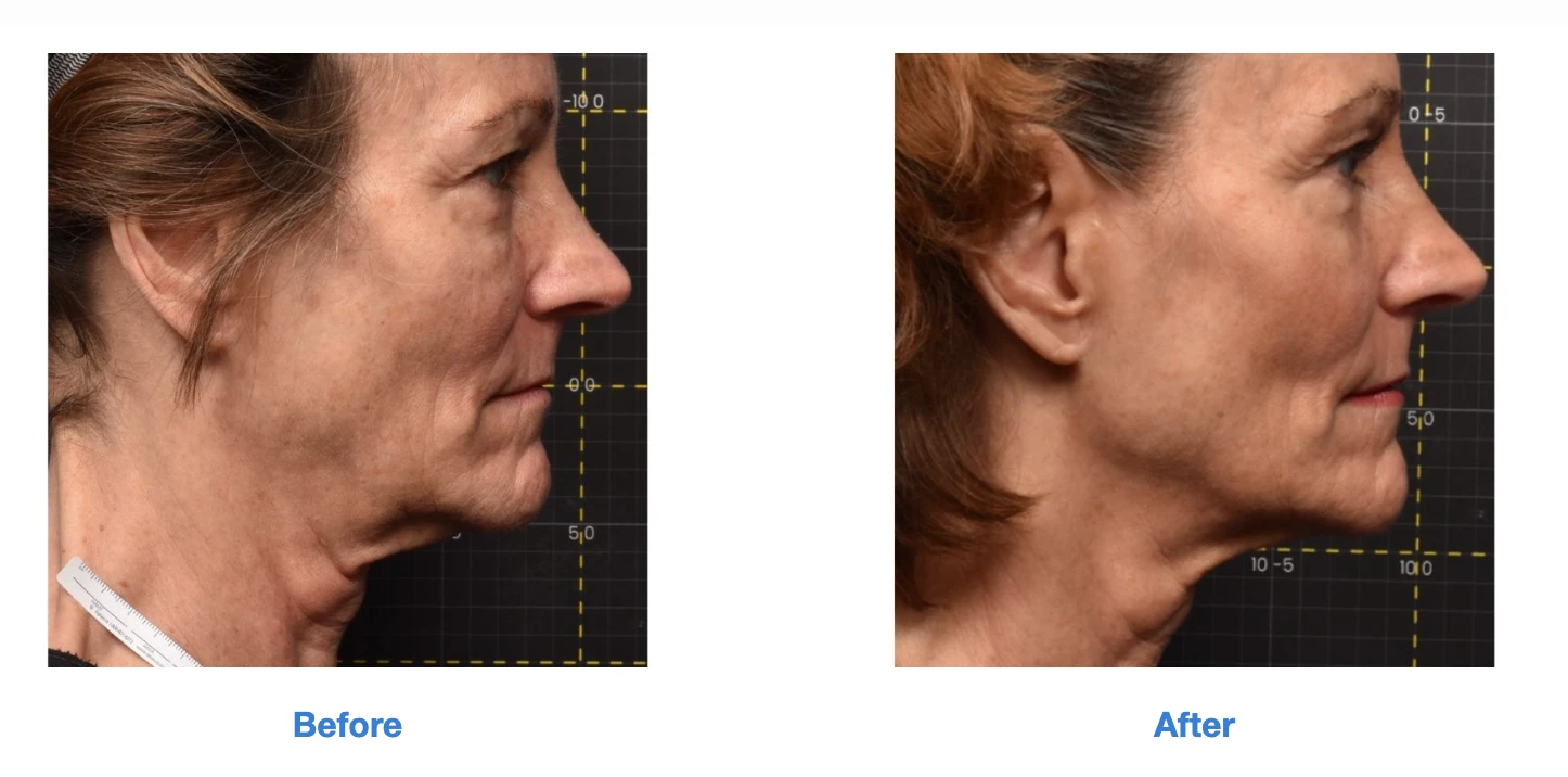 Before and after Sofwave treatment for facial skin tightening