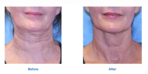 Sagging Neck treatment before and after Images 2nd by Radiance Skin and Laser in Bothell, WA