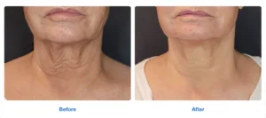 Sagging Neck treatment before and after Images by Radiance Skin and Laser in Bothell, WA