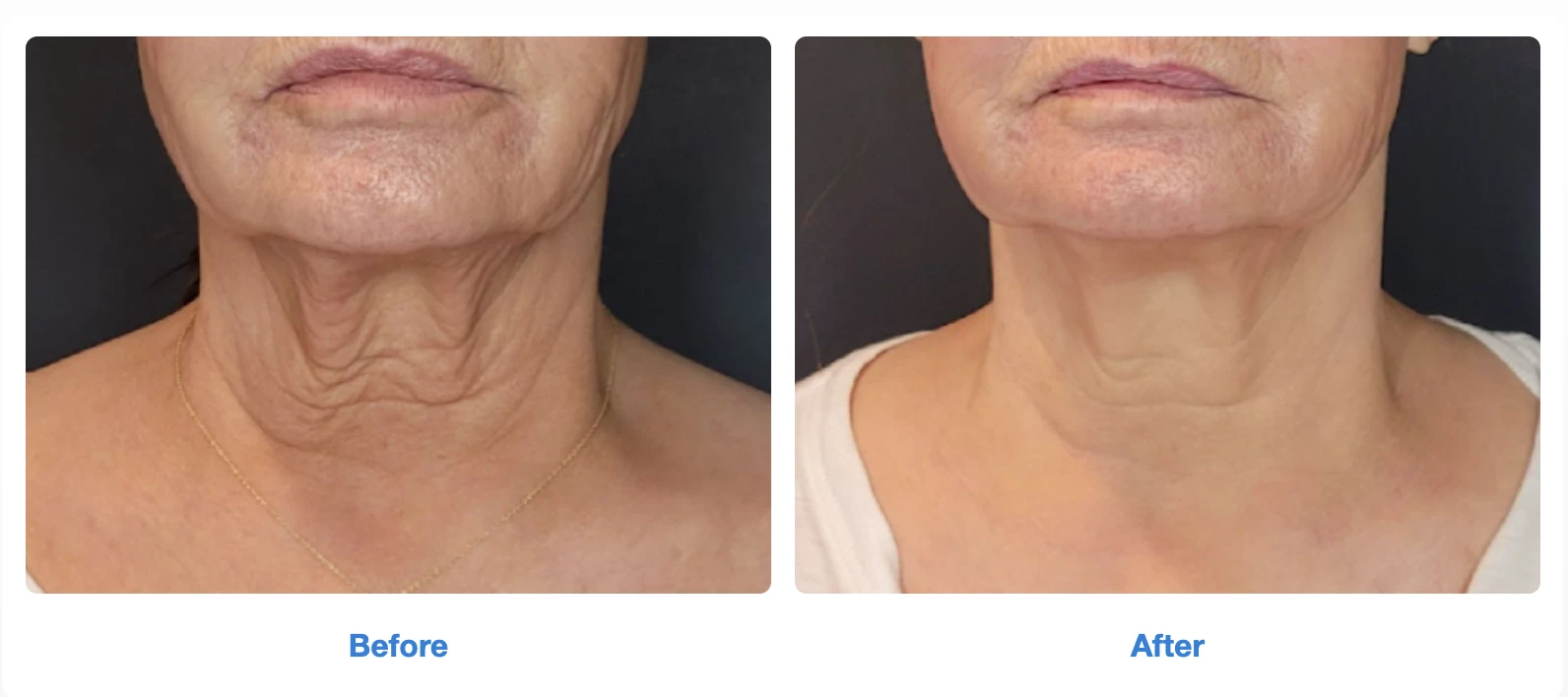 Neck treatment before and after images 2nd by Radiance Skin and Laser in Bothell, WA