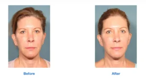 Face treatment Images before and after 2nd by Radiance Skin and Laser in Bothell, WA