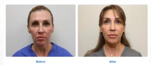 Face treatment Images before and after by Radiance Skin and Laser in Bothell, WA