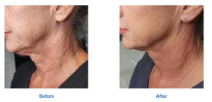 Neck before and after images by Radiance Skin and Laser in Bothell, WA