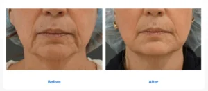 Wrinkle treatment before and after images by Radiance Skin and Laser in Bothell, WA