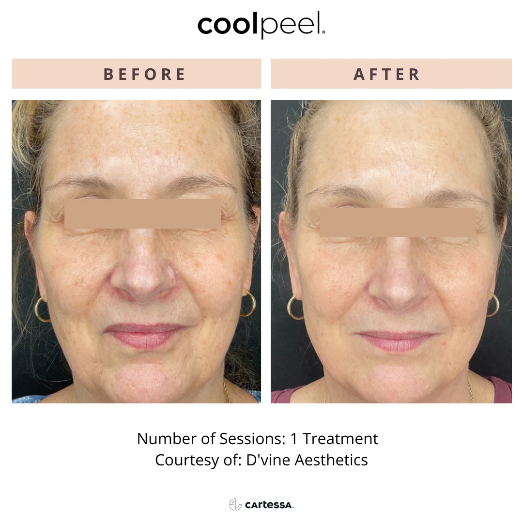 special before and after radianceskinlaser a