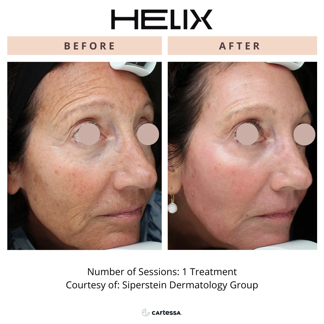 special before and after radianceskinlaser b