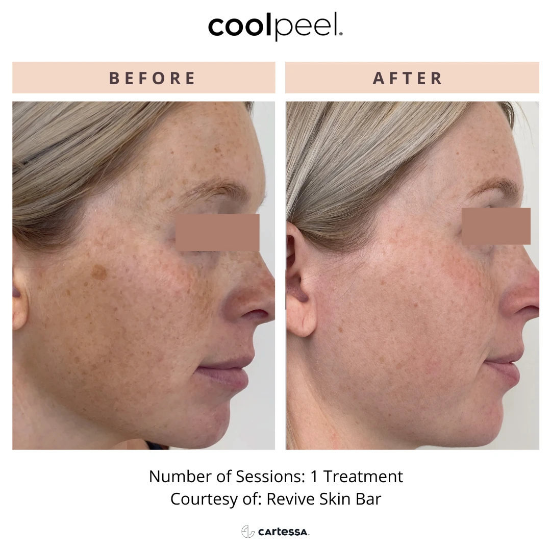 special before and after radianceskinlaser c