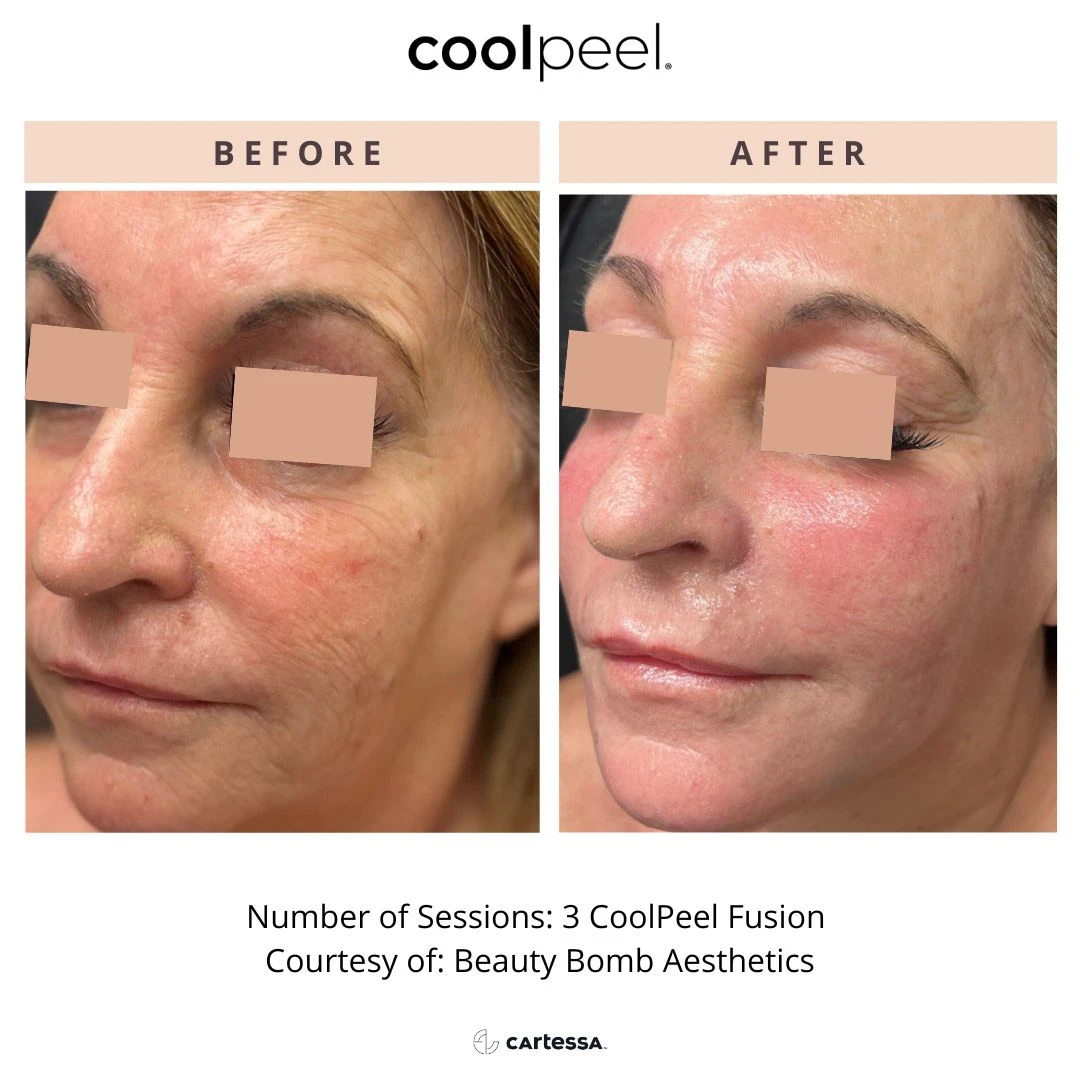 special before and after radianceskinlaser d