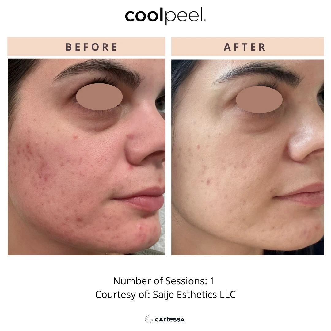special before and after radianceskinlaser e