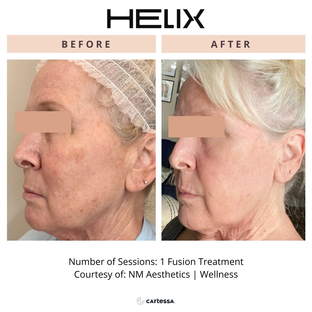 special before and after radianceskinlaser f