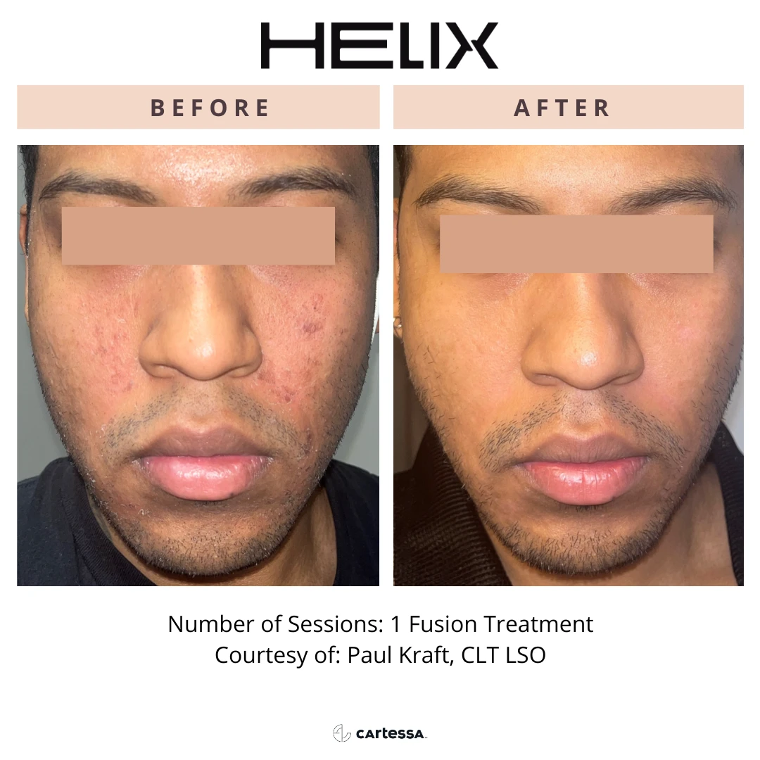 special before and after radianceskinlaser g