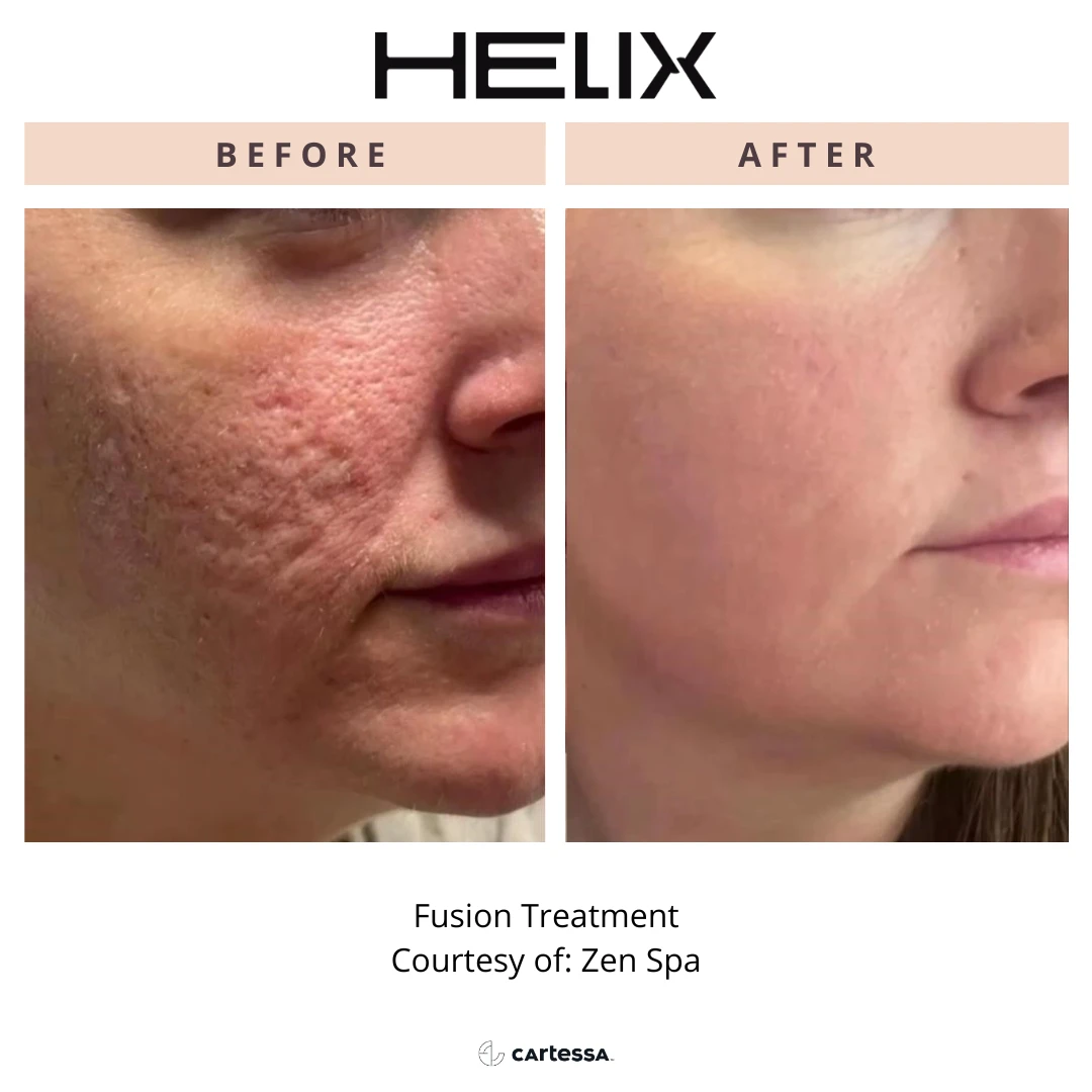special before and after radianceskinlaser h