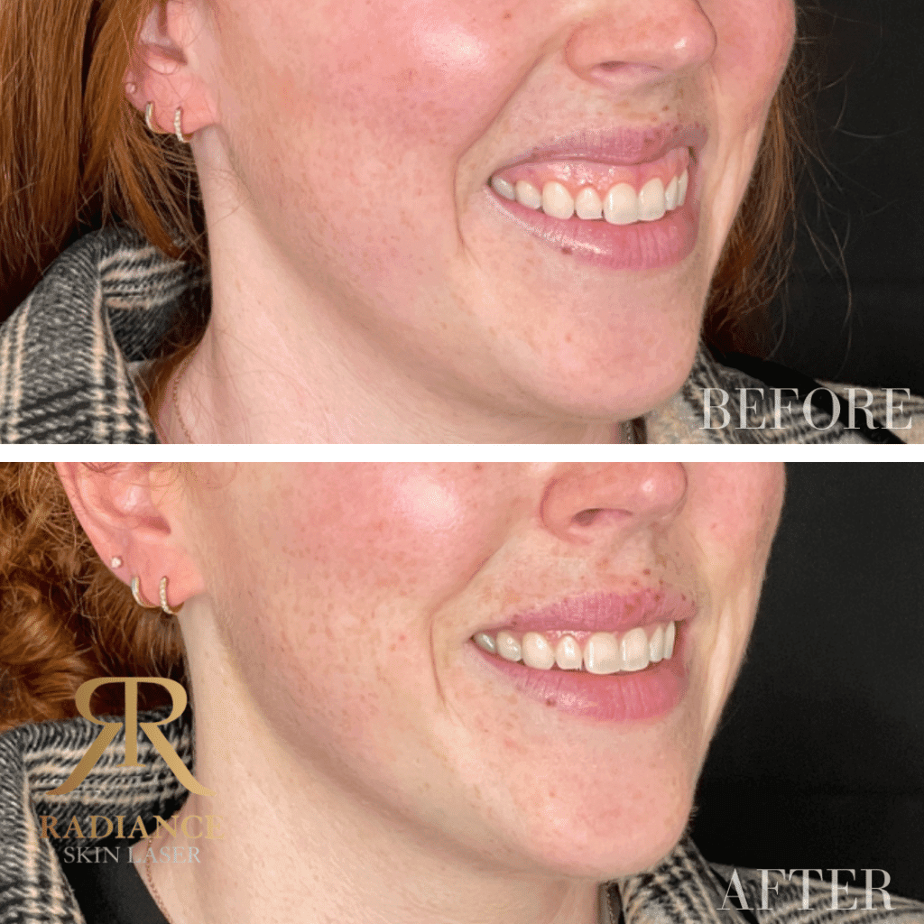 Before And After Radiance Skin And Laser